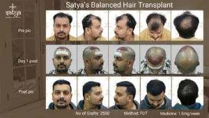 Satya/ Truth of Hair Transplant