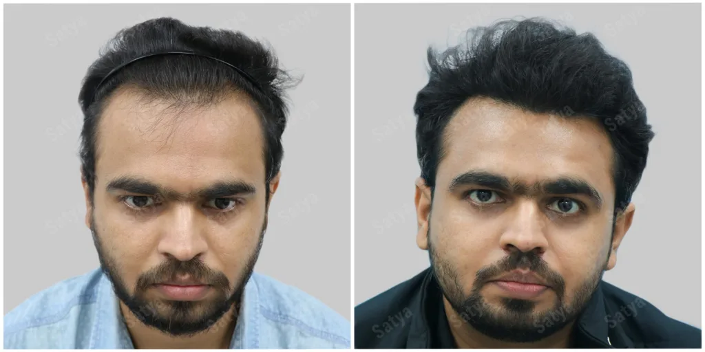 hair transplant in Indore