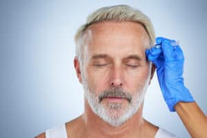 For A Hair Transplant, How Many Grafts Are Required For Men?