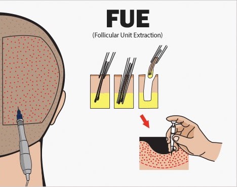 Follicular Unit Extraction