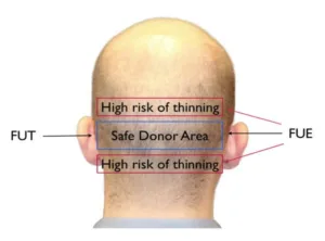 Does hair transplant regrowth occur in the donor area?