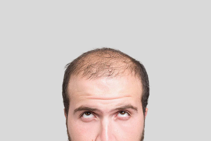 Male_pattern_baldness