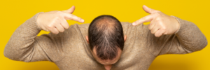 WHAT IS THE BEST WAY TO FIGHT MALE PATTERN BALDNESS?