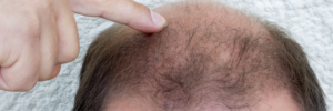 DIFFERENCE BETWEEN HAIR LOSS AND HAIR SHEDDING