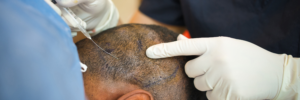 Which hair transplant method is the best, and why?