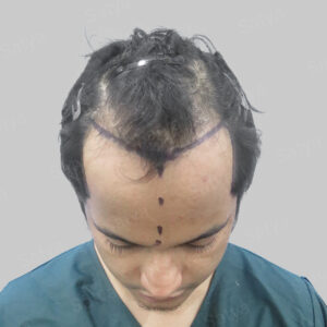 frontal hair transplant