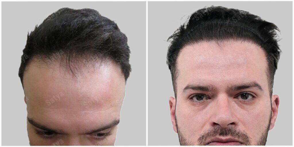 hair transplant canada patient result before after