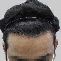 repair hair transplant result