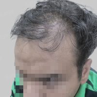 wrong hair transplant