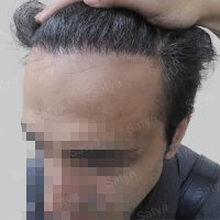 wrong hair line repair
