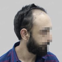repair hair transplant result in India