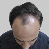 repair hair transplant