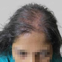 female hair transplant surgery
